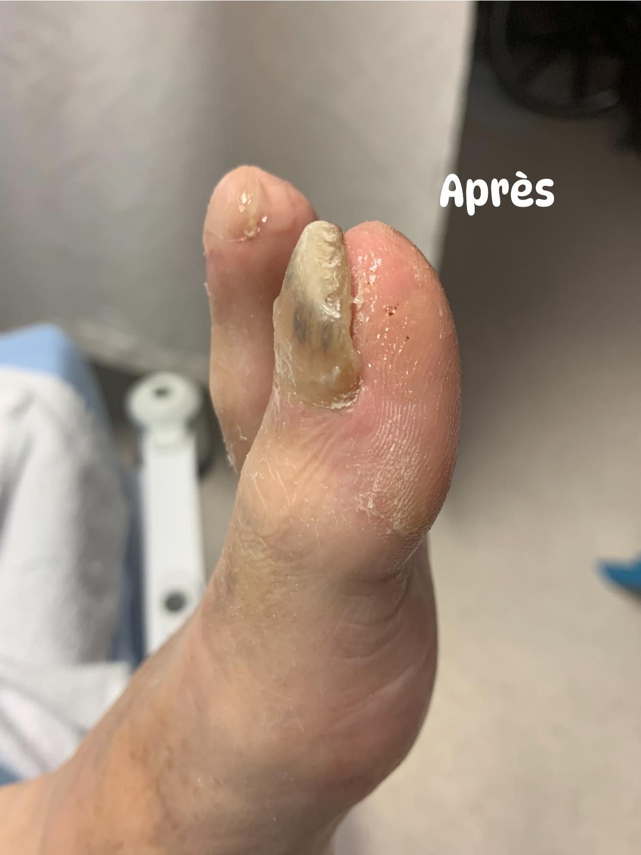 Après — ongle traité