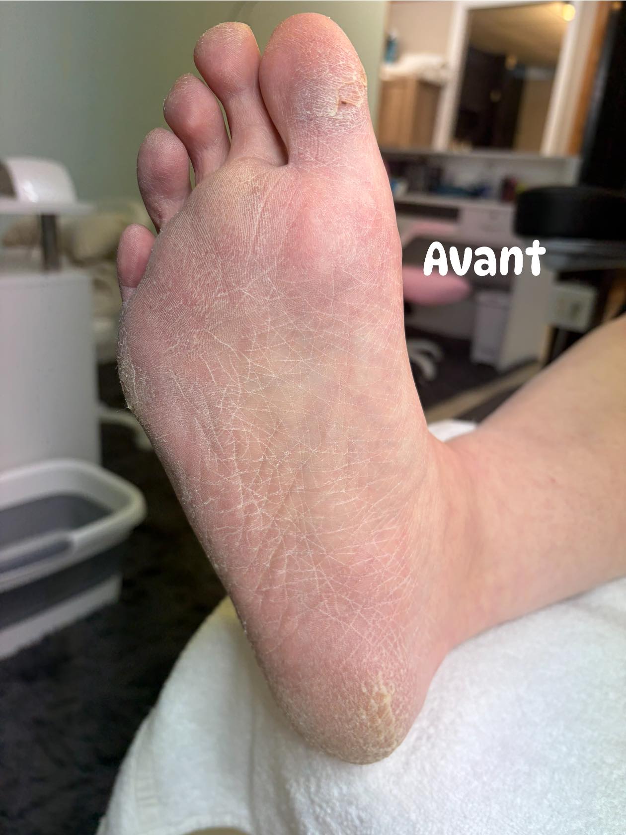 Avant — peau sèche