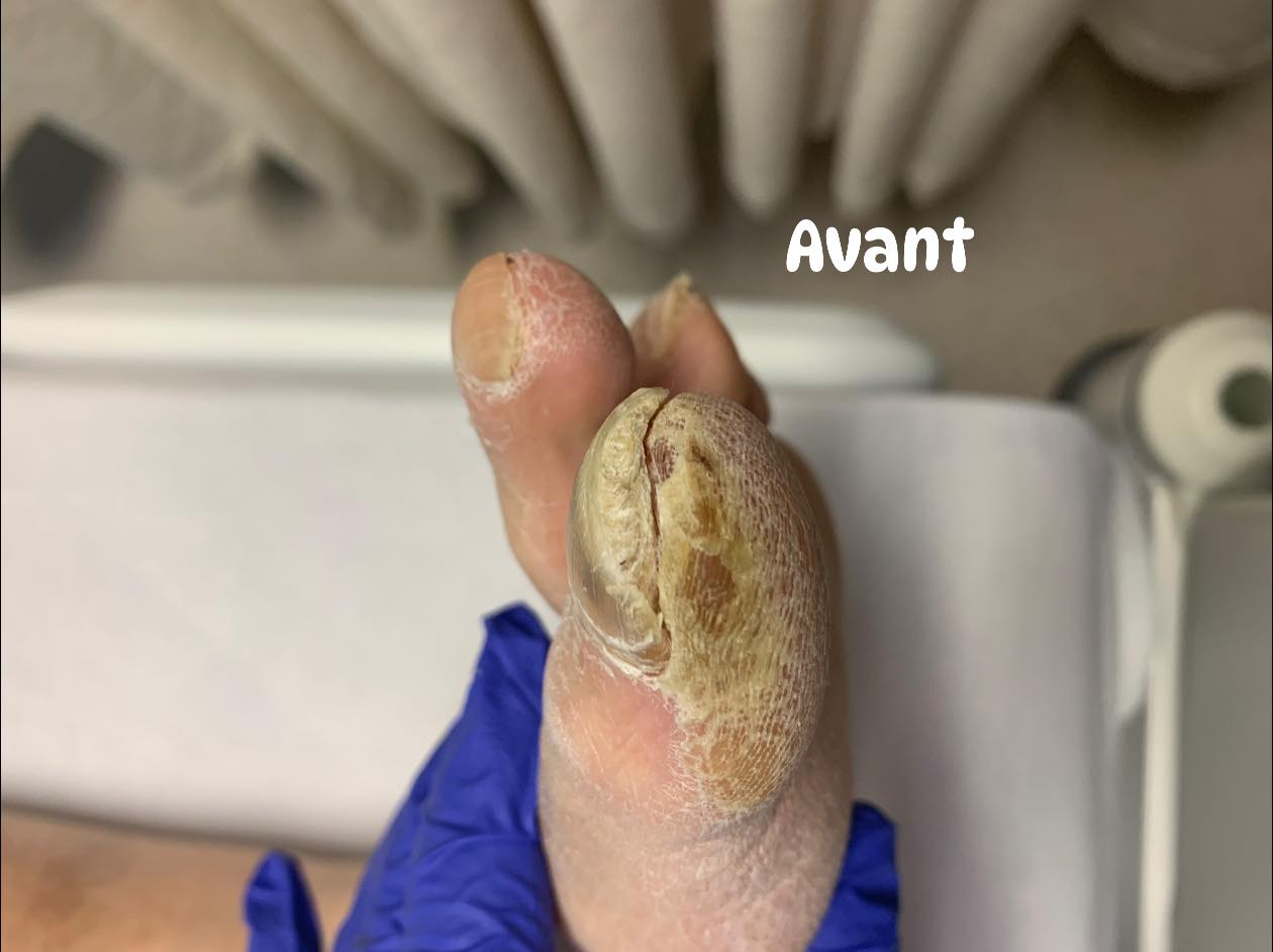 Avant — ongle mycosé