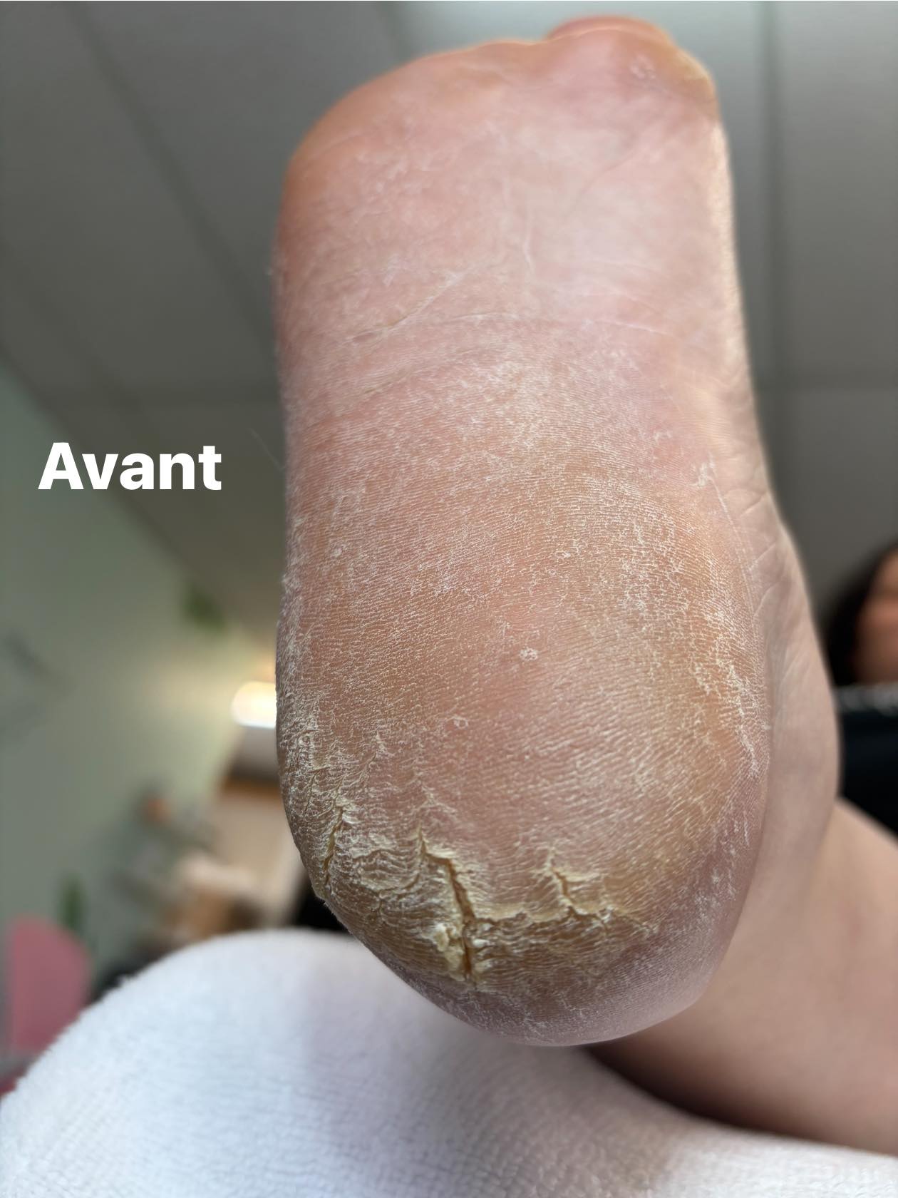 Avant — talon fissuré