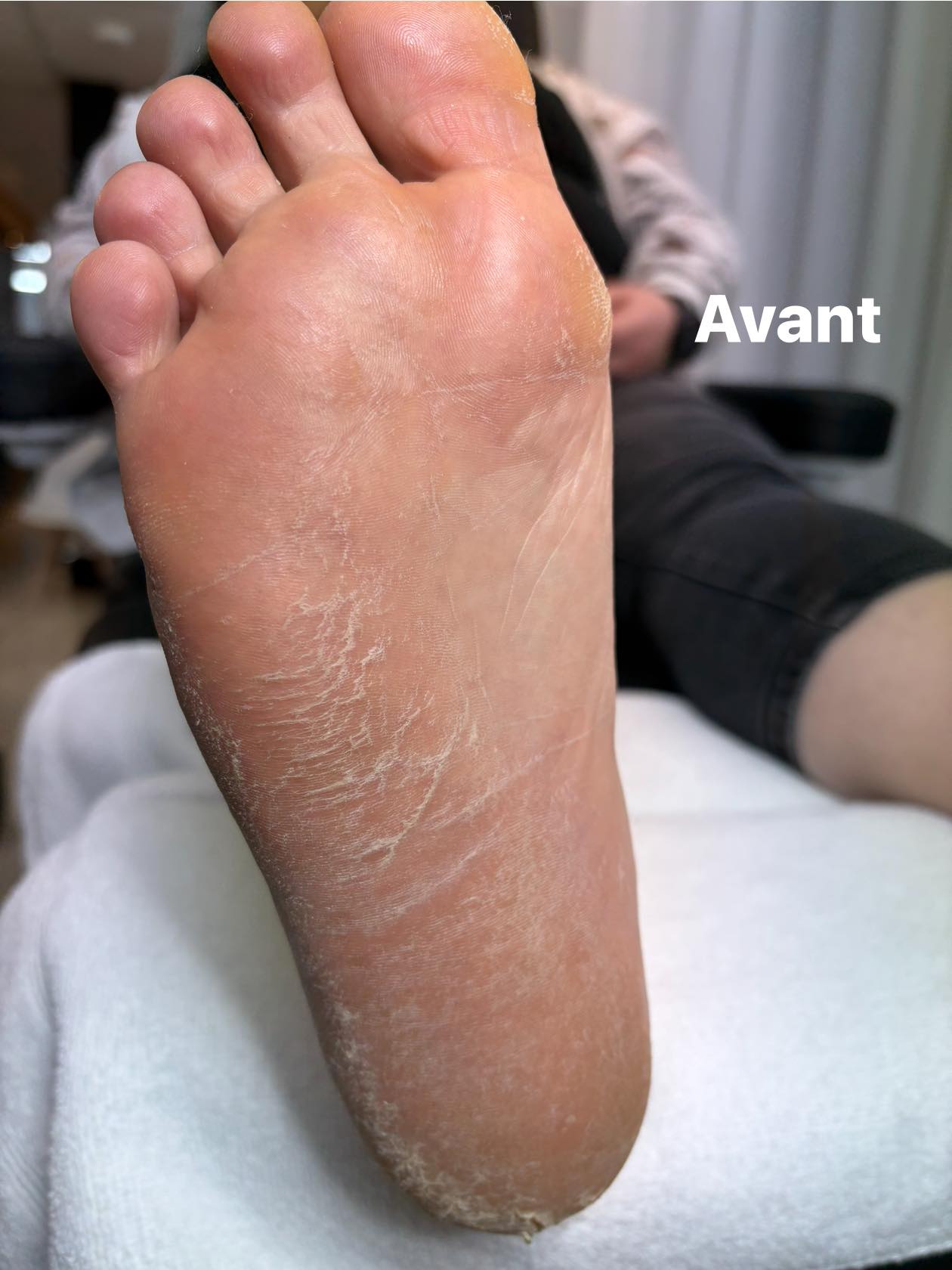 Avant — peau rugueuse